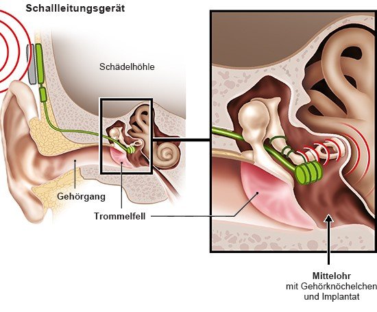 Grafik: Hörgerät mit Implantat im Mittelohr