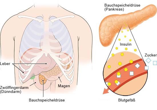 Diabetes Typ 1