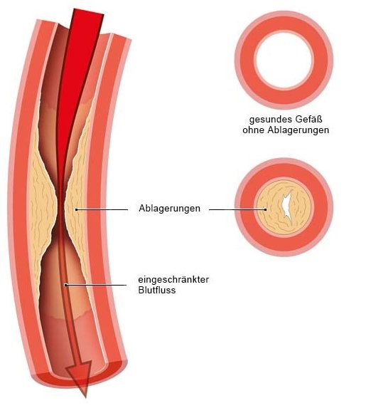 Grafik: Verengte Arterie