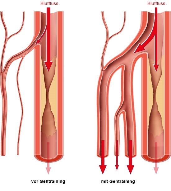 Grafik: Vergrößerung und Neubildung von Nebengefäßen durch Gehtraining 
