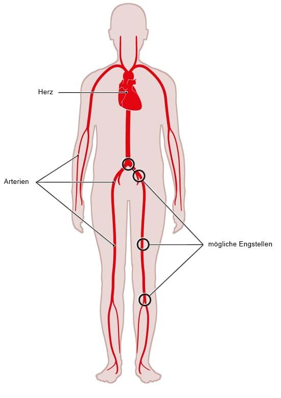 Grafik: Blutkreislauf und Lage möglicher Engstellen bei einer PAVK