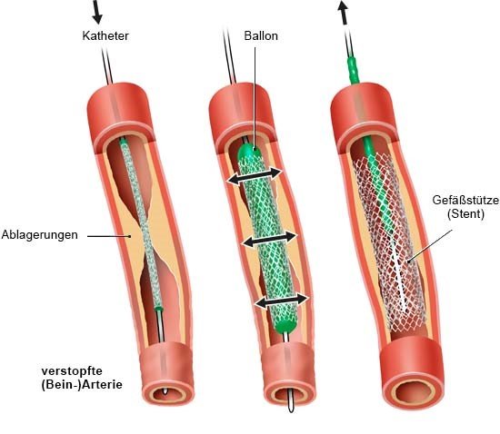 Grafik: Katheter mit Ballon und Stent 