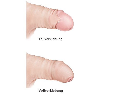 Grafik: Phimose: Teil- und Vollverklebung zwischen Vorhaut und Eichel