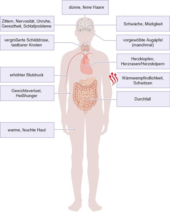 Grafik: Eine Schilddrüsenüberfunktion kann viele unterschiedliche Symptome hervorrufen