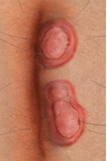 Grafik: Sogenannte Condylomata lata an der Pofalte