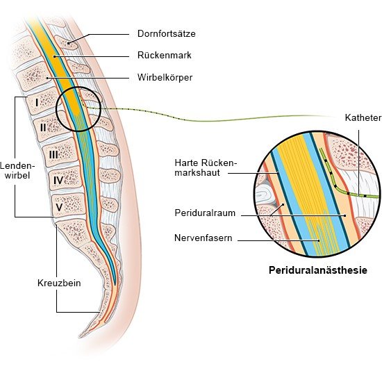 Grafik: Periduralanästhesie (PDA)