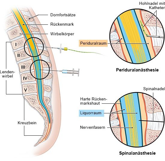 Grafik: Rückenmarksnahe Betäubung: PDA und Spinalanästhesie