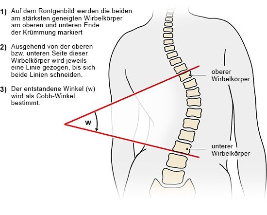 Grafik: Ermittlung des Cobb-Winkels