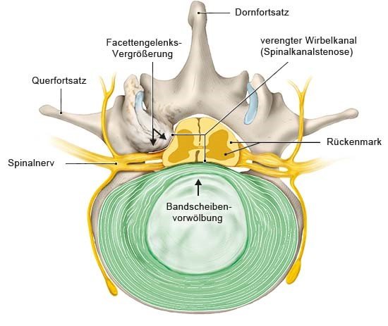 Grafik: Verengung des Spinalkanals, Querschnitt, Ansicht von oben