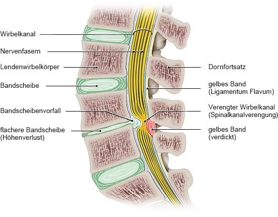 Grafik: Verengung des Spinalkanals, Längsschnitt, Ansicht von der Seite