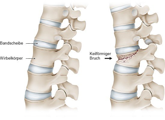 Grafik: Links gesunde Wirbelsäule, rechts Wirbelkörperbruch