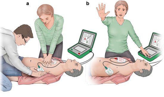 Grafik: Anwendung eines Defibrillators: a) Anbringen der Elektroden und Herzdruckmassage, b) Schocktaste betätigen, dabei bewusstlose Person nicht berühren