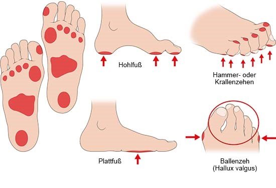 Grafik: Besonders gefährdete Stellen für eine Wunde bei diabetischem Fußh