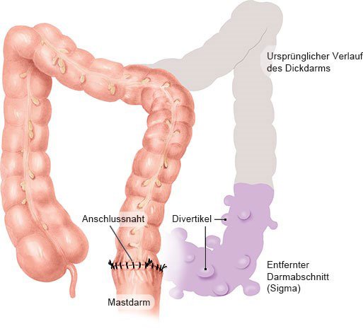 Grafik: Sigmaresektion: das häufigste Operationsverfahren bei Divertikelkrankheit - wie im Text beschrieben