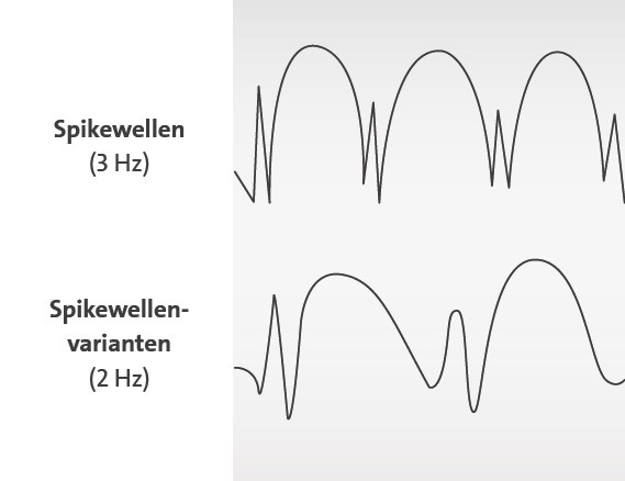 Die Grafik zeigt ein EEG mit Spikewellen und Spikewellen-Varianten bei Epilepsie