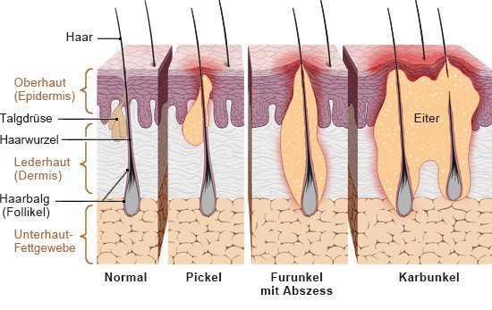 Oder pickel furunkel Furunkel im