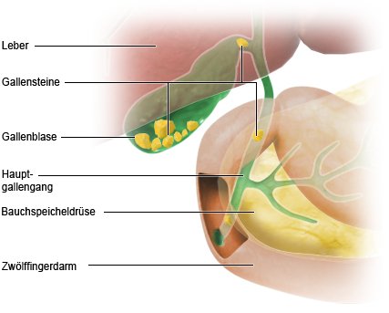 Grafik: Darstellung von Gallensteinen - wie im Text beschrieben
