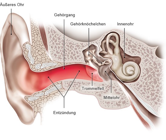 Grafik: Entzündung im äußeren Gehörgang