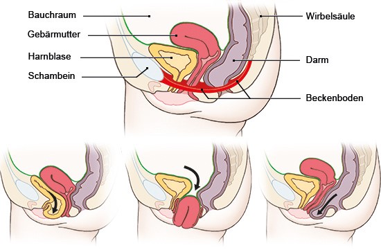 rafik. Oben: normale Lage der Organe im Beckenraum; unten: links Blasensenkung, Mitte Gebärmuttervorfall, rechts Mastdarmsenkung