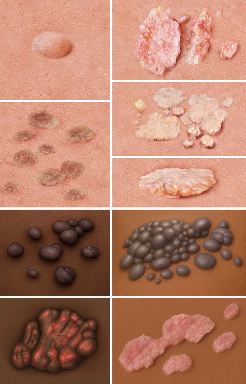 Die fotorealistischen Grafiken zeigt, wie verschieden Feigwarzen aussehen können.