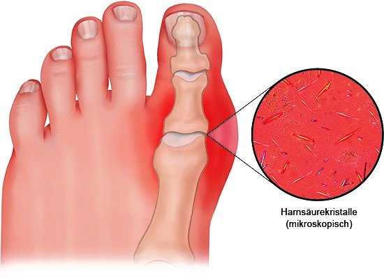 Grafik: Bei Gicht lagern sich winzige Kristalle aus Harnsäure vor allem in Gelenken ab