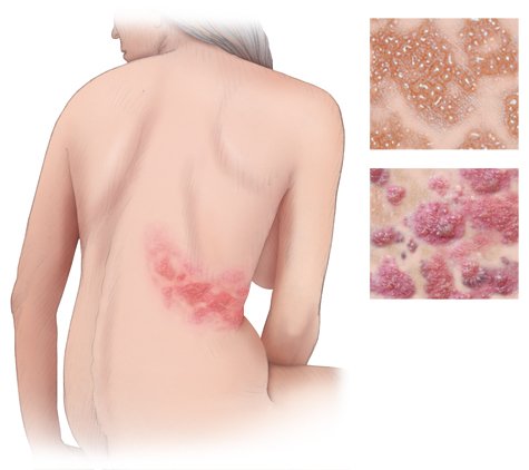 Gurtelrose Gesundheitsinformation De