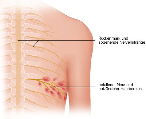 Grafik: Von Viren befallener Nerv und entzündeter Hautbereich