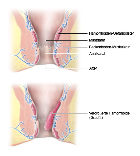 Hämorrhoiden-Gewebe, Ansicht im Längsschnitt: normal und vergrößert - wie im Text beschrieben