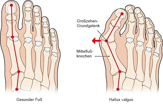 Grafik: Gesunder Fuß und Hallux valgus - wie im Text beschrieben