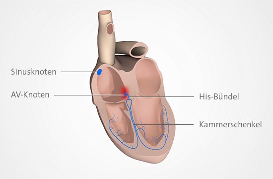 Grafik: Beim AV-Block ist die Reizweiterleitung am Herzen gestört