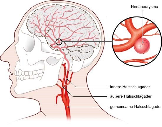 Grafik: Ein Hirnaneurysma sitzt oft mitten im Gehirn