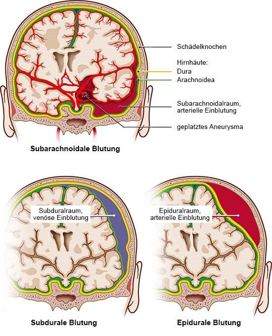 Grafik: Verschiedene Hirnblutungen