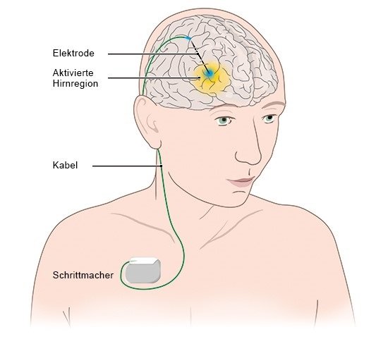 Grafik: Bei der THS werden elektrische Impulse in bestimmte Hirnregionen gesendet