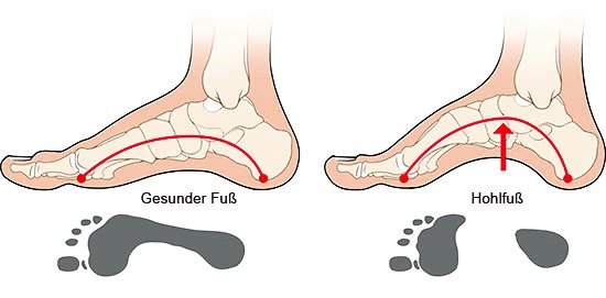 Grafik: Gesunder Fuß und Hohlfuß - wie im Text beschrieben