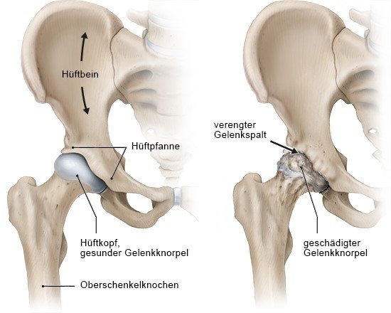 Dauert schleimbeutelentzündung hüfte lange Schleimbeutelentzündung in