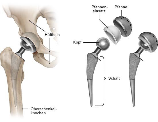 Grafik: Geradschaft-Gelenkprothese, unzementiert: links Sitz nach Operation, rechts Einzelteile - wie im Text beschrieben