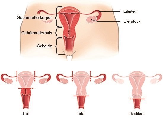 Nach gebärmutterentfernung regelblutung Gebärmutterentfernung