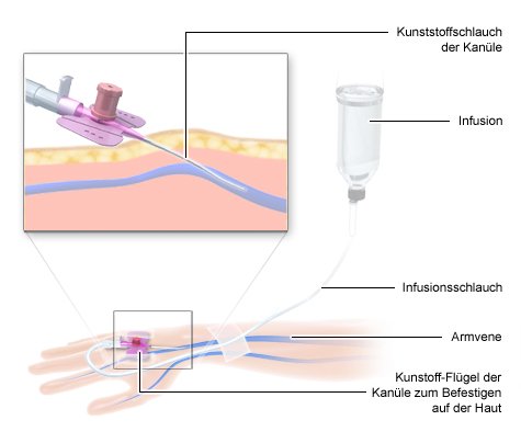 Grafik Chemotherapie: Infusion in eine Vene