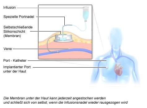 Grafik Chemotherapie: Infusion über einen Port