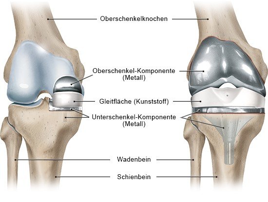 Grafik: Ansicht: rechtes Knie von vorn; links: Teilprothese, rechts: Vollprothese - wie im Text beschrieben