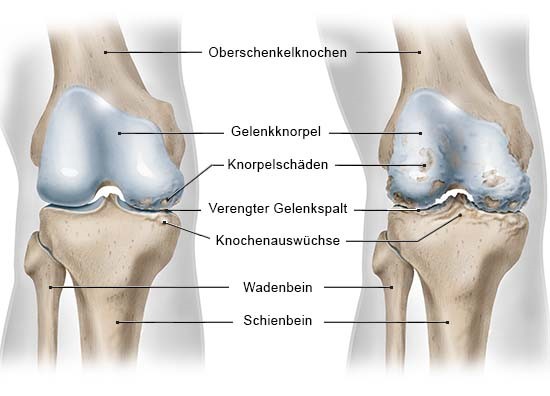 Grafik: Ansicht rechtes Knie von vorn ohne Kniescheibe; links mit einseitiger Arthrose (medial), rechts mit fortgeschrittener beidseitiger Arthrose (medial und lateral)