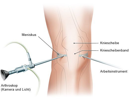 Grafik: Kniespiegelung (Arthroskopie)