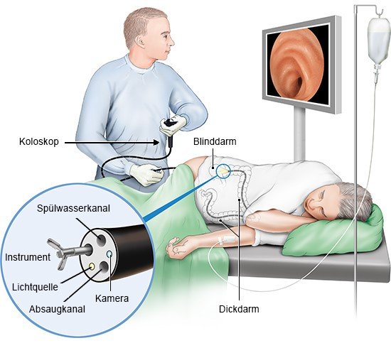Der darmspiegelung periode während Extreme Kraempfe