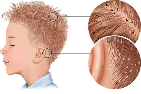 Grafik: Kopfläuse und Nissen im Haar - wie im Text beschrieben