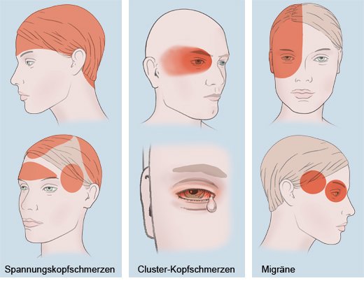 Grafik: Häufige Kopfschmerzarten: Stellen, an denen sie typischerweise auftreten - wie im Text beschrieben