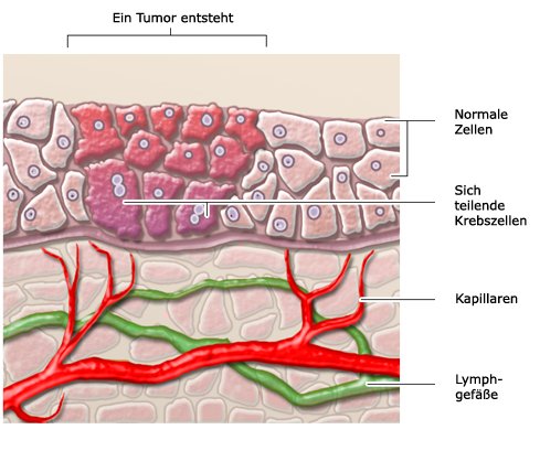 Grafik: carcinoma in situ