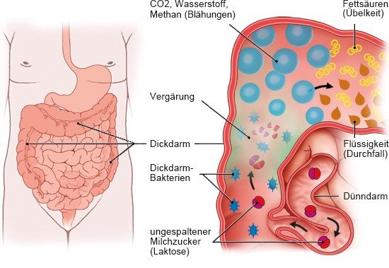 Grafik: Verdauung bei Laktoseintoleranz - wie im Text beschrieben