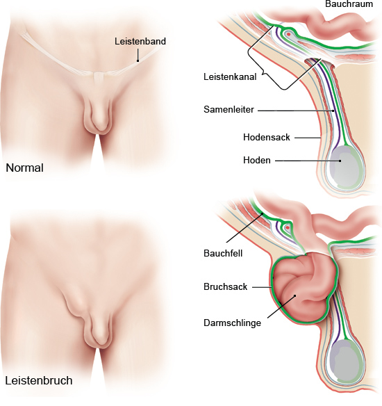 Grafik: Leistenbruch: Schwachstelle Leistenkanal