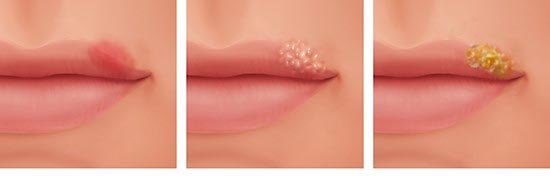 Was bedeutet Herpes an der Lippe?