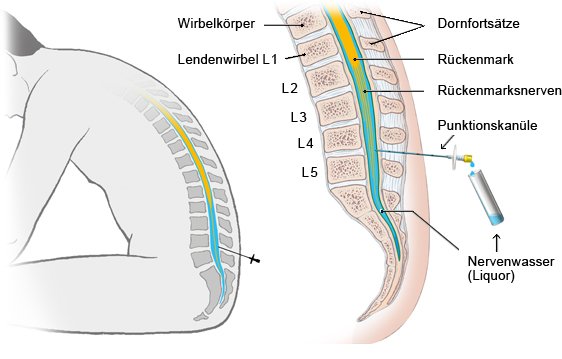 Grafik: Lumbalpunktion im Bereich der Lendenwirbel - wie im Text beschrieben